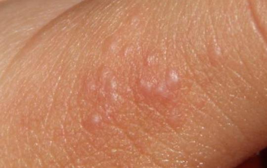 宝宝手上长湿疹怎么办?