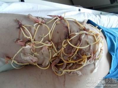 肛瘘的病因有哪几种