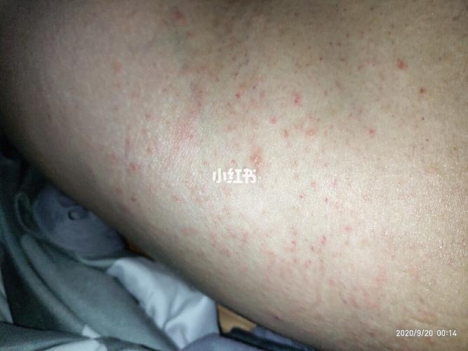 皮肤突然长这红点,特别痒,是什么?