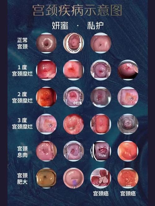 宫颈糜烂二度前都很好解决_宫颈糜烂_白带_医疗健康