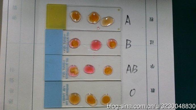 血型反应——自编实验指导