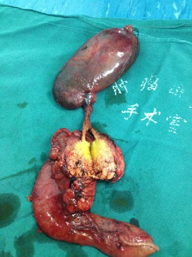 治疗胰腺癌的最佳手术方式--改良胰十二指肠切除术 (原创)