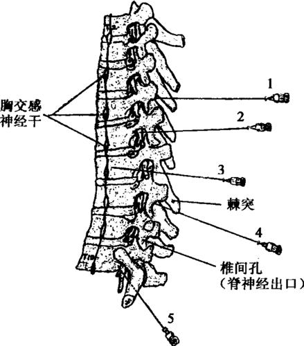 医学 颈腰肢痛诊疗 正文 (2) 胸椎棘突和椎间孔的关系 (图4-79): 上部