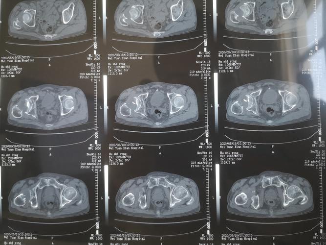 入院ct检查提示股骨颈骨折.