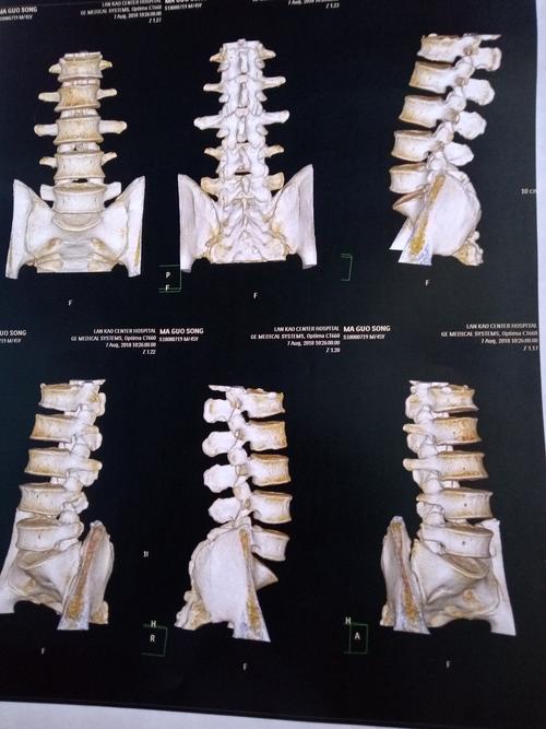 腰椎三维重建片