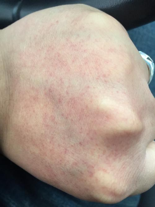 昨晚喝过白酒 今天早上起来突然发现手背长了好多红点