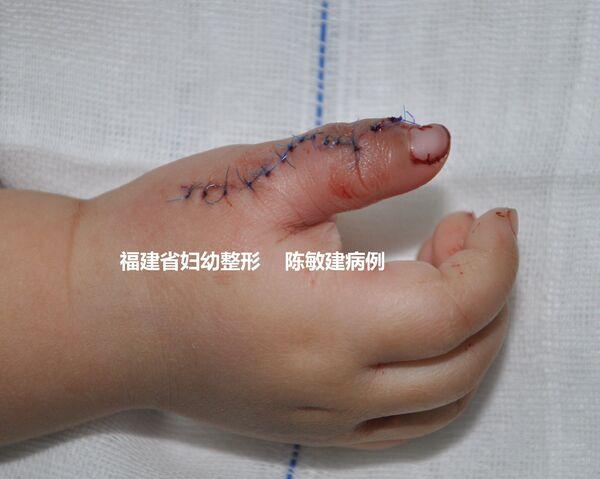 Ⅳd型(蟹钳样)复拇指畸形手术前后对比图片