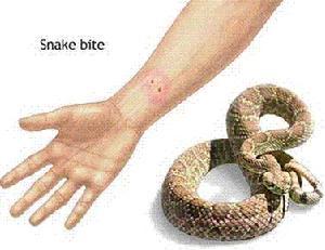 被蛇咬伤