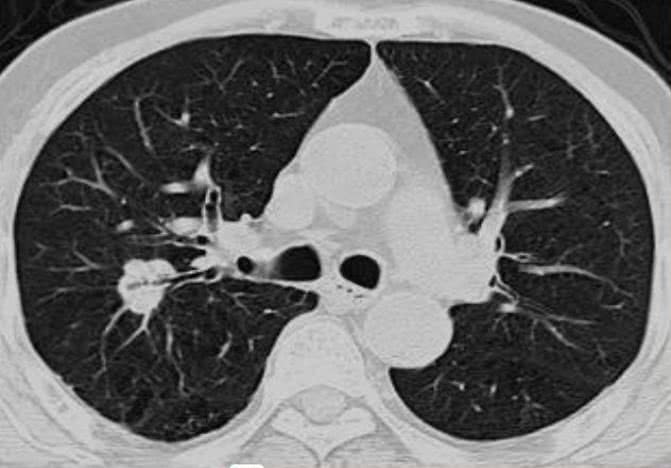 白红利教授:肺结节ct报告的解读