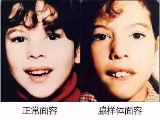 孩子总是张嘴睡觉正常吗?
