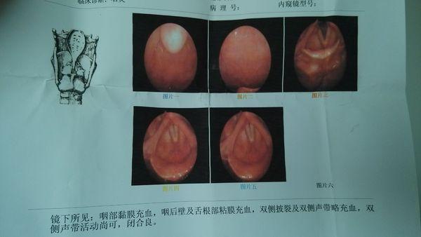 慢性喉炎声带及双侧披裂慢性充血