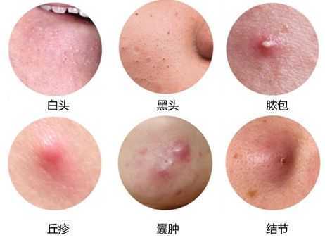 按照痘痘的不同,我们来具体看下治疗方法,以及如何从饮食上控制痘痘