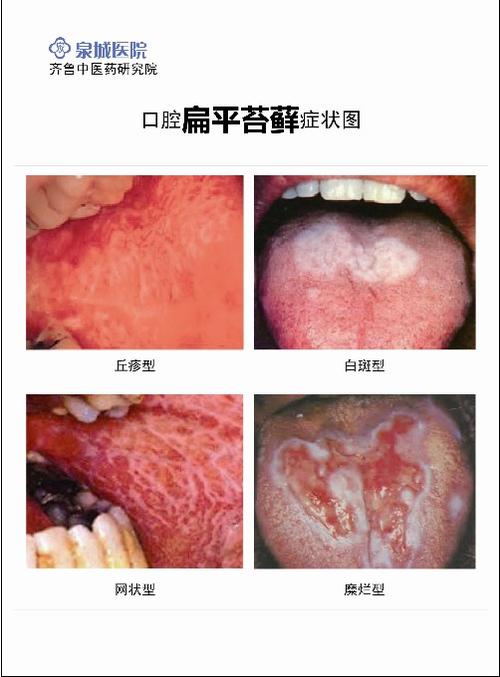 口腔粘膜扁平苔癣的图片_泉城医院口腔扁平苔藓_新浪