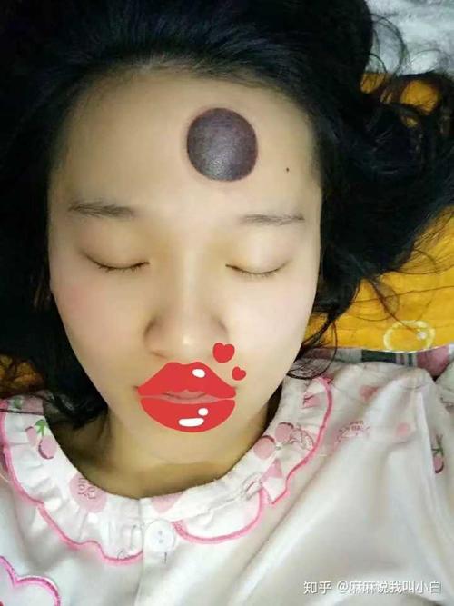 额头可以拔罐吗