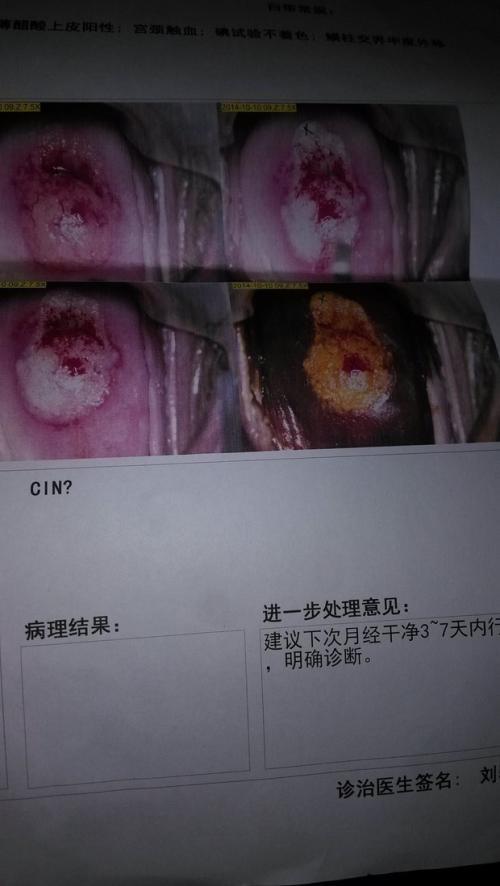 宫颈白色上皮