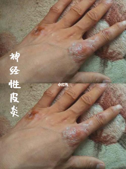神经性皮炎 手上也不知道是怎么回事那个样子了,我以为过几天就会好