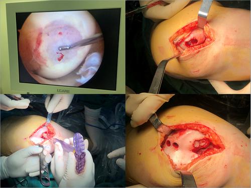 b 超引导下髋关节穿刺诊疗术