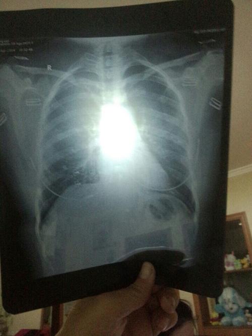 问:我想知道这个胸透的阴影可能是什么