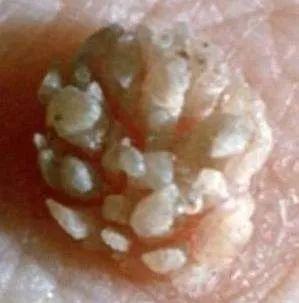 常见的性病为淋病,表现为泌尿生殖系统的化脓性炎症,有尿道口红肿流脓