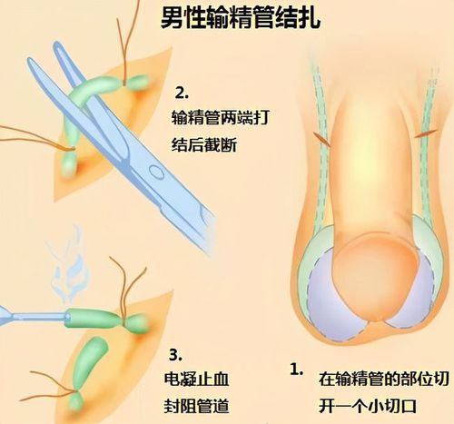 输精管结扎术,扎还是不扎?|睾丸|手术|附睾_网易订阅