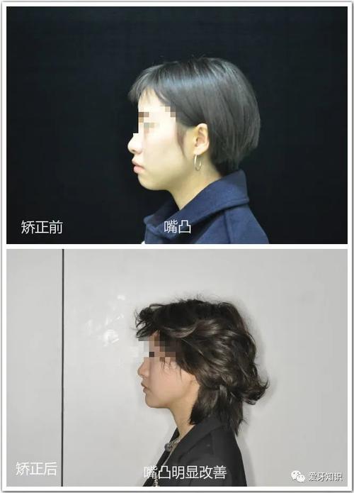 成都女孩通过牙齿矫正改变嘴凸,变化太大了!
