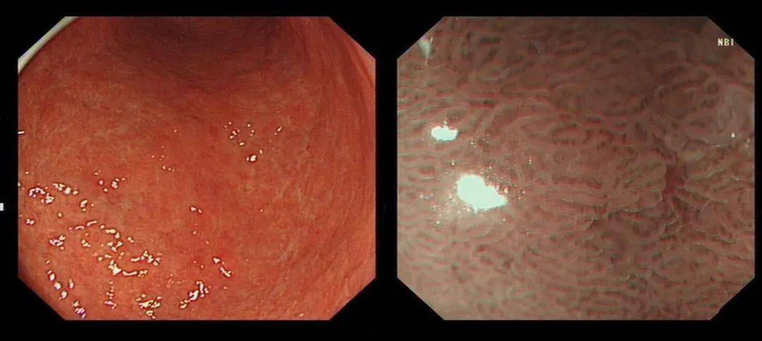 慢性萎缩性胃炎是慢性胃炎的一种类型.