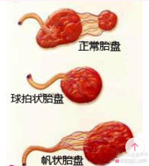 有谁知道什么是帆状胎盘吗?