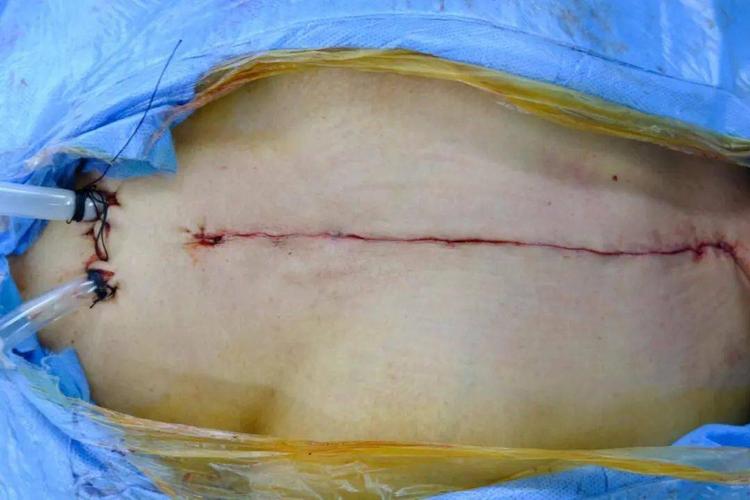手术结束缝合的伤口