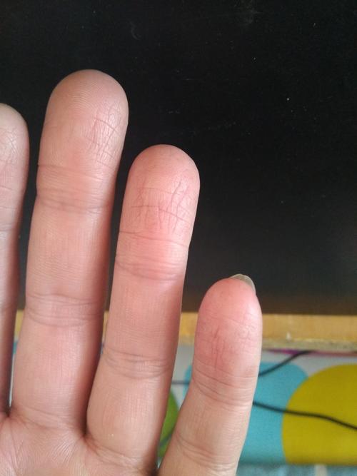 手指肚干瘪皱纹很多怎么回事?