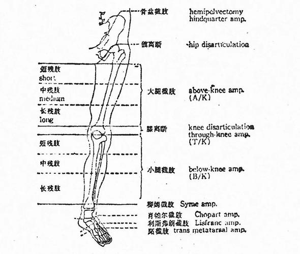 想要假肢效果好,截肢部位很关键!(下肢篇)