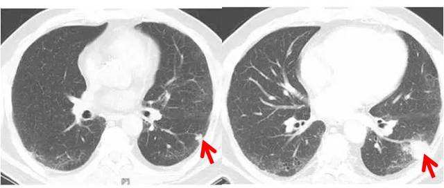 年年体检都没事,今年做了ct,为什么一下子就肺癌晚期了?