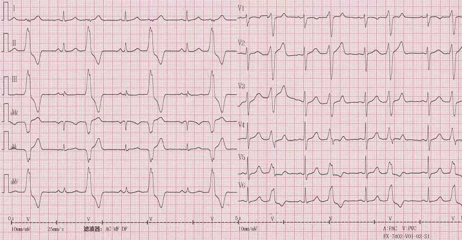 李女士的心电图提示为室早二联律