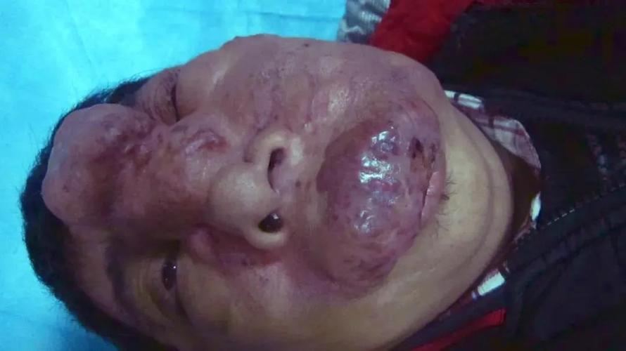 面部血管瘤患者有哪些饮食注意事项,这些细节都很重要