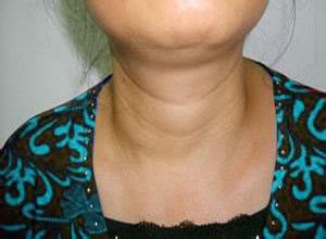 甲状腺功能减退症