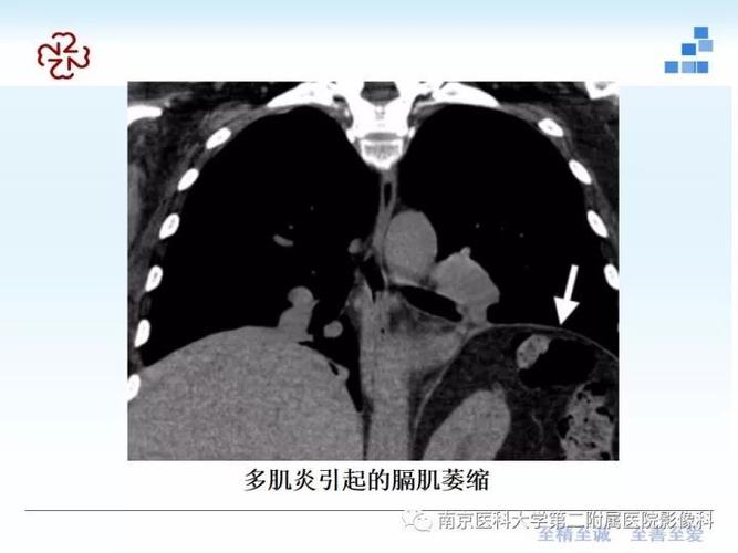膈肌的解剖及常见病变影像表现
