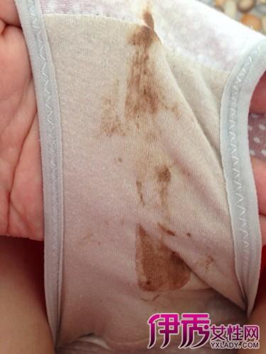 宫腔积脓,宫颈癌