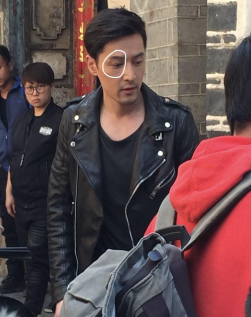 胡歌烫伤脸真实照吓坏网友毁容后患无穷