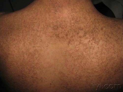 全身皮肤角化鳞屑,色素沉着20余年.