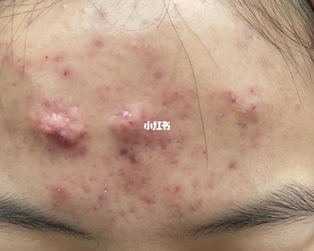 囊肿结节痘痘_痘痘_博乐达怎么样_刷酸_医疗健康_医疗