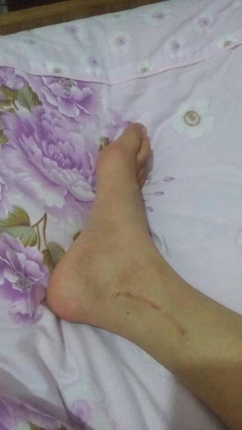 年前不小心崴脚,致使右脚后踝,外踝骨折,内固定手术后