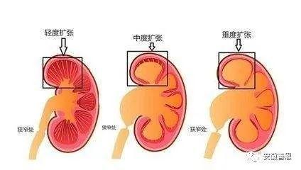 孕期b超检出宝宝肾盂分离的多是男宝宝吗
