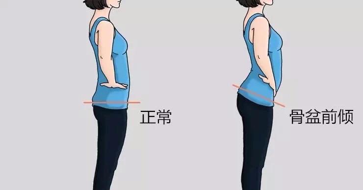 日常生活中,如果你有下面这些"习惯",说明你可能就是骨盆前倾
