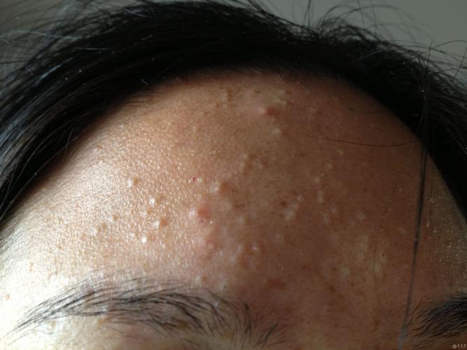 这个脸上的皮疹怎么治疗啊?维a软膏用了不见效果,继续求帮助