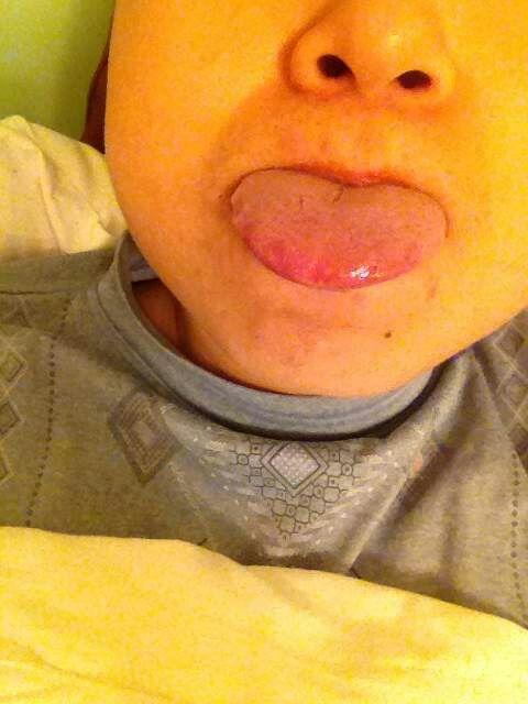 想请教一下大师,近几日舌头边缘呈锯齿状,舌头红白粗糙,有干裂状纹.