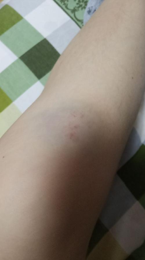 昨天骑行不慎摔倒 磕破了膝盖