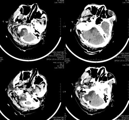 枕骨大孔脑膜瘤1例