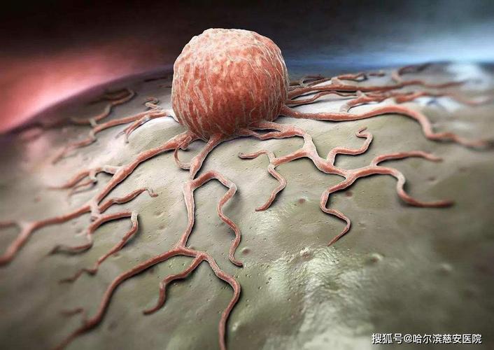 【科普】 恶性肿瘤:肉瘤.