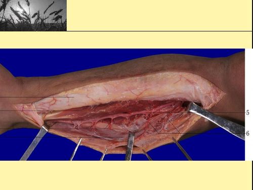 胫后动脉穿支皮瓣