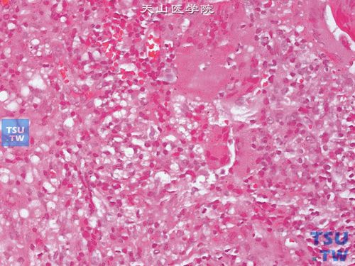 结核性膀胱炎及bcg导致的肉芽肿病理图谱