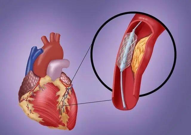 一分钟讲明白,心脏搭桥/支架分别是咋回事